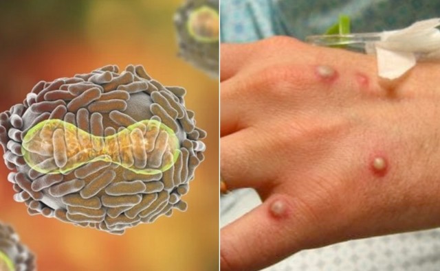 Ministerul Sănătății: Ce este variola maimuței, care sunt simptomele și cum se răspândește?
