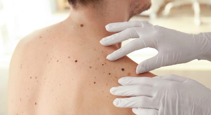 Descoperire halucinantă: Cancerul de piele e mai frecvent la cei care stau la sat