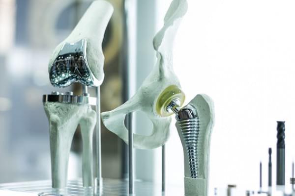 Studiu: Femeile sunt mai sensibile la implanturile din metal pentru înlocuirea articulațiilor decât bărbații