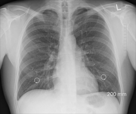 A mers la spital crezând că are TBC, dar medicii i-au găsit un prezervativ în plămâni