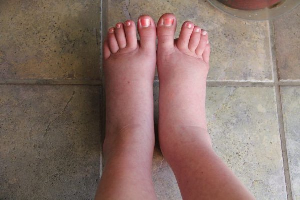 Medic: Picioarele umflate ar putea fi un semn al unui cancer tăcut