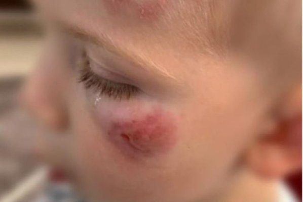  Șocant: Copil mușcat de față, de mai multe ori, de un coleg de grădiniță