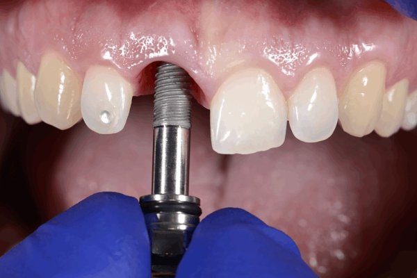 Implantul dentar - partenerul care îți asigură o viață normală și de calitate