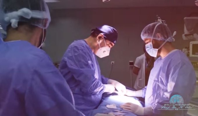 Tumoră gigant de 20 de centimetri dezvoltată pe vertebre, operată cu succes la Spitalul de Neurochirurgie Iași
