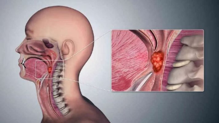 Răgușeala și durerile în gât persistente pot fi semnele cancerului laringian