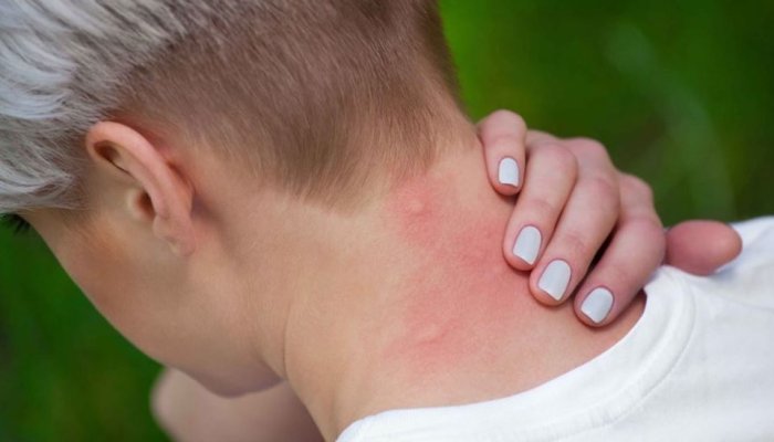 Cum să îți treacă mâncărimea provocată de la înțepătura de țânțar: 7 remedii care funcționează