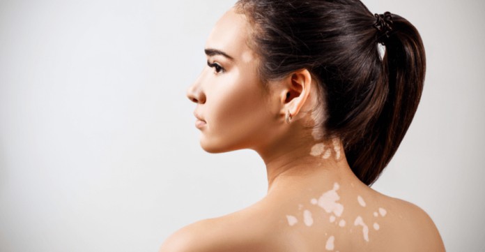 Vitiligo – Cum se manifestă, complicații, factori de risc, tratament