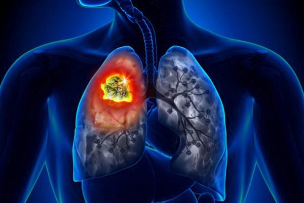 Legătura dintre aportul excesiv de vitamina B și cancerul pulmonar